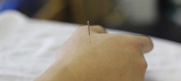 Intramuscular Stimulation (IMS), Dry Needling treatment at Sheddon physio clinics in Burlington
