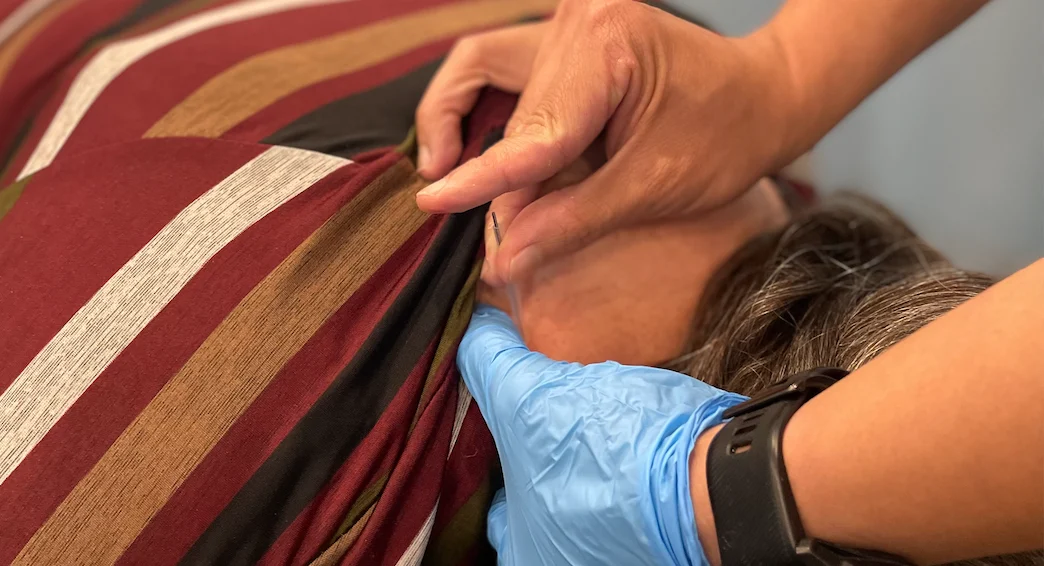 dry needling benefits physio clinic Burlington