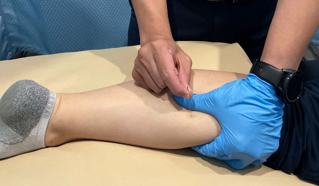 dry needling benefits physiotherapy clinic Burlington