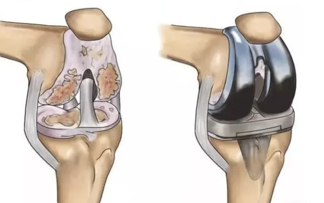 Knee implant components overview