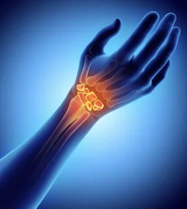 Median nerve compression causing wrist pain