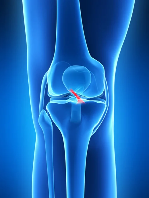 ACL injury rehab guide Burlington